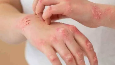 Psoríase afeta autoestima de pacientes e pode gerar inflamação das articulações