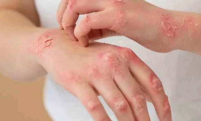 Psoríase afeta autoestima de pacientes e pode gerar inflamação das articulações