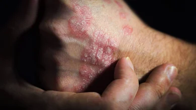 Psoríase afeta autoestima de pacientes e pode gerar inflamação das articulações