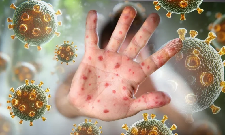 Department of Health unveil two new measles exposure sites in the South West