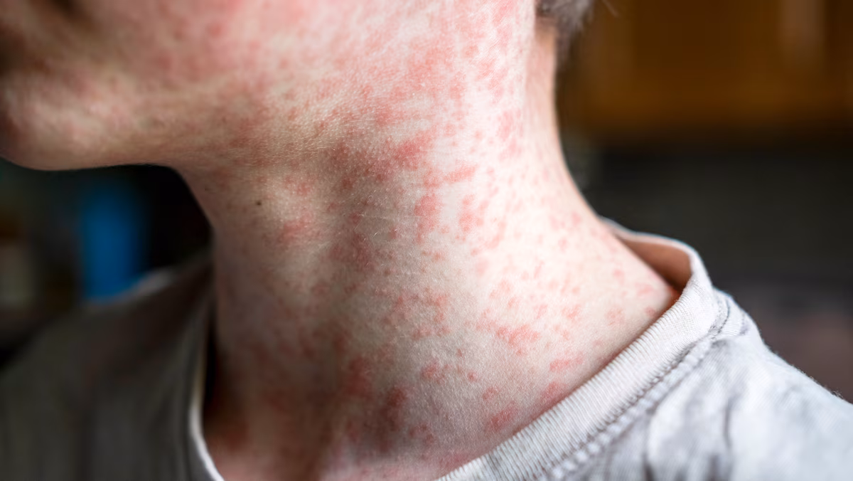 Épidémie de rougeole: le Canada perd son statut d’élimination de la maladie