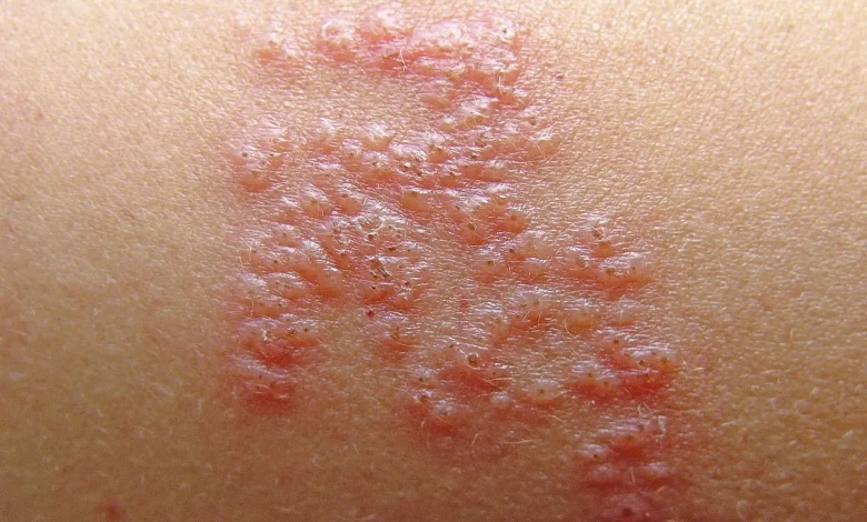 The Vaccine That Adults 50+ Shouldn’t Skip