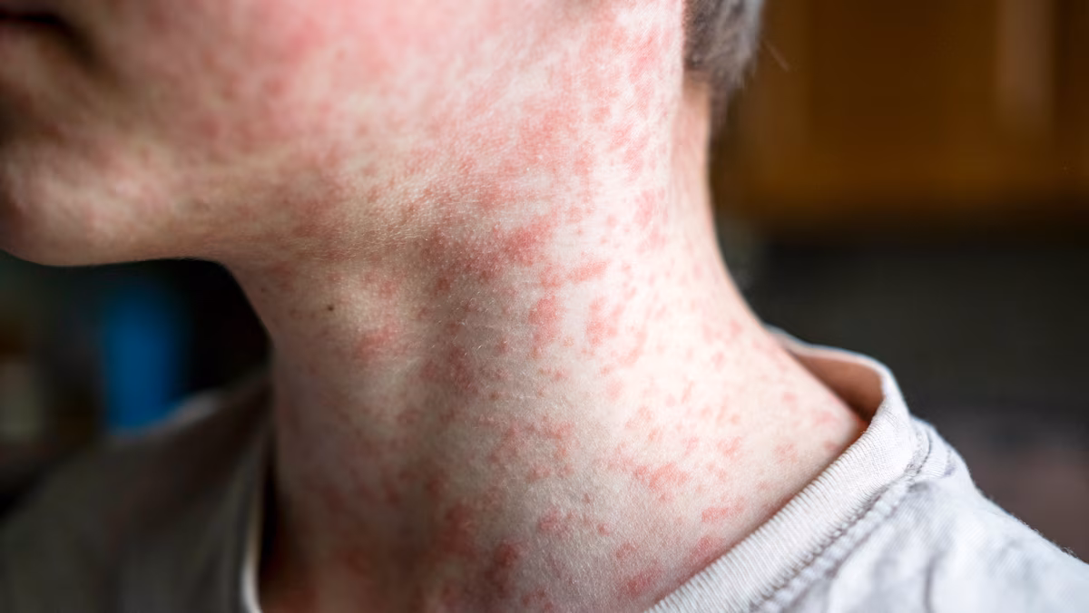 3 cas de rougeole confirmés au Québec