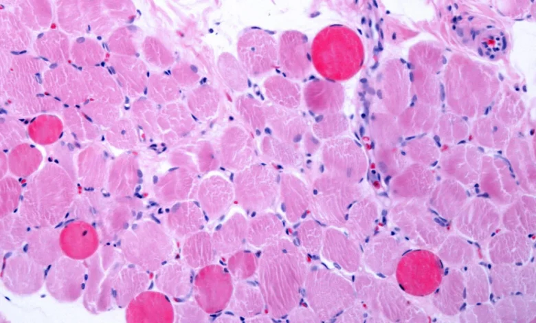 Capricor says its cell therapy improved heart and muscle function in Duchenne patients