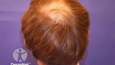 Clascoterone 5% Delivers Strong Phase 3 Hair-Growth Results