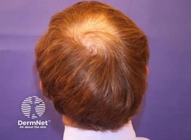 Clascoterone 5% Delivers Strong Phase 3 Hair-Growth Results