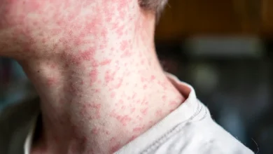 Measles Outbreaks Accelerate as U.S. Inches Closer to a Disease Tipping Point