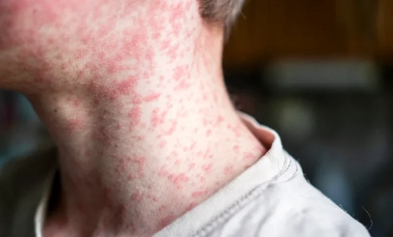 Measles Outbreaks Accelerate as U.S. Inches Closer to a Disease Tipping Point