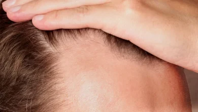 New Baldness Drug Boosted Hair Growth by 539% in Trials
