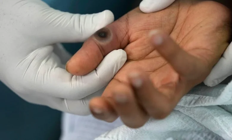 New 'hybrid' mpox strain detected in England as health officials issue alert