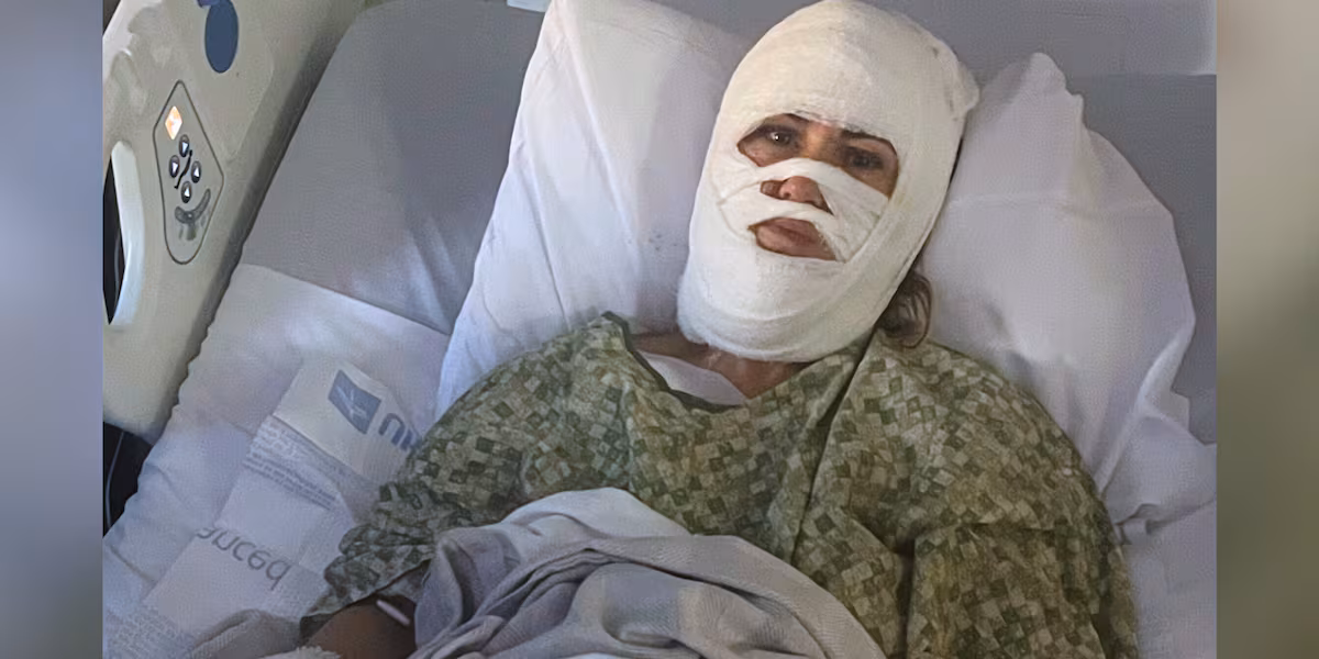 Savannah woman attacked with acid, recovering at Augusta burn center